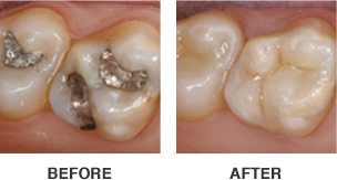 CEREC-before-after-image-304×163